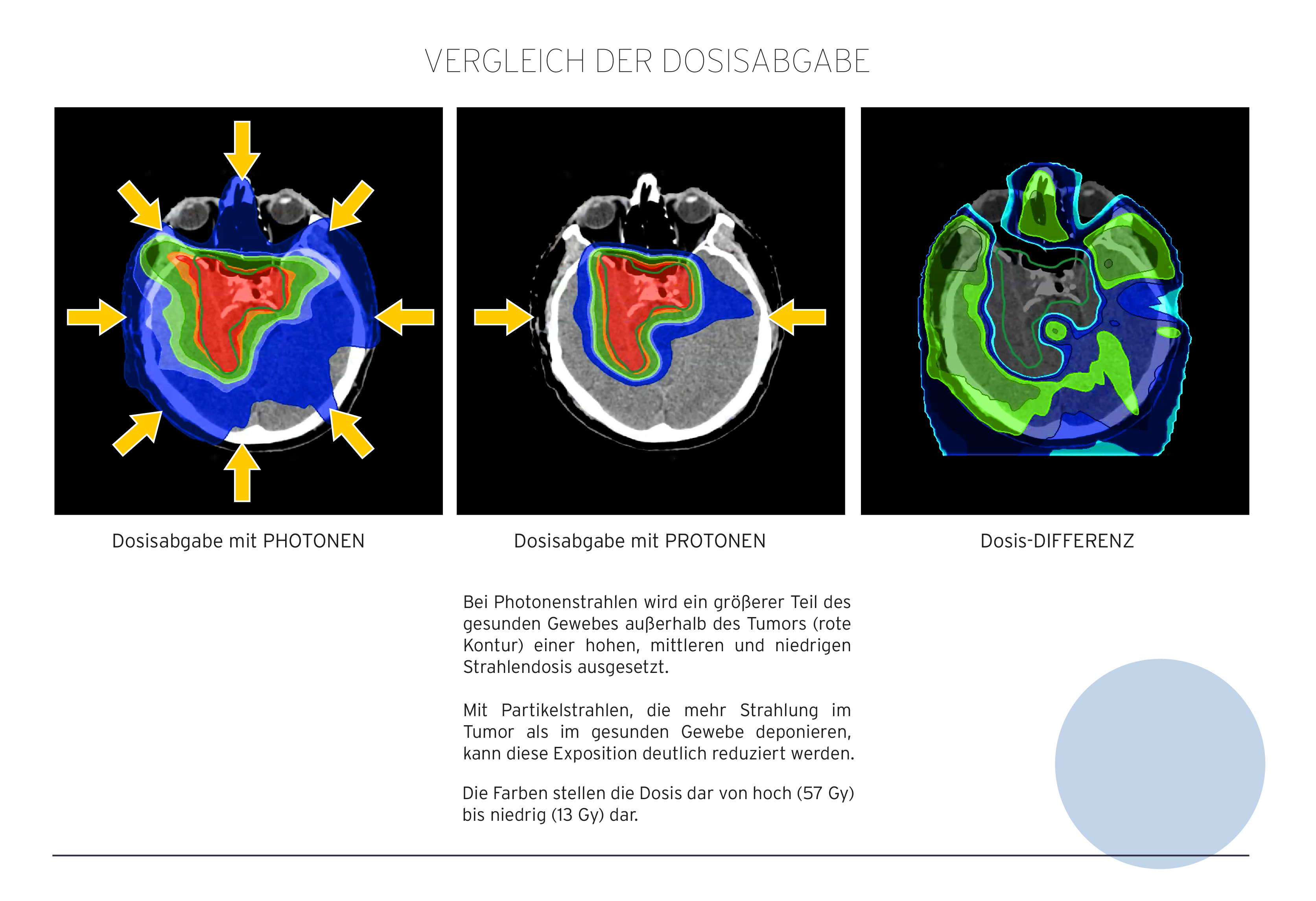 Abb. 2: Photonen vs. Protonen: Dosisdeposition im Tumor und gesunden Gewebe.