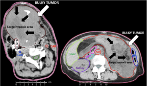 Bulky Tumor Examples