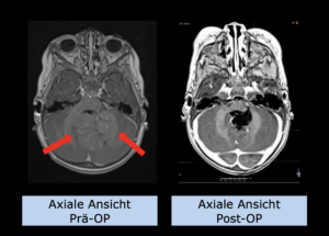Beispiel Pädiatrie: Ependymom