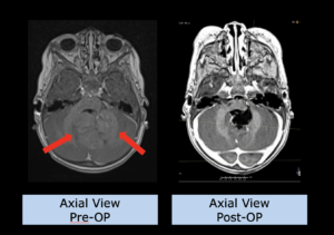 Example Pediatrics: Ependymoma