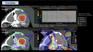 Treatment Plan Comparison Ependymoma