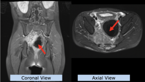 Example Pediatrics: Ewing Sarcoma