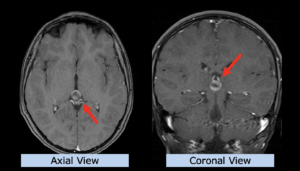 Example Pediatrics: Germinoma