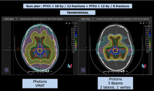 Treatment Plan Comparison Germinoma I