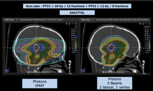 Treatment Plan Comparison Germinoma II