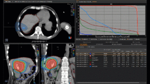 Animation: treatment plan hepatocellular carcinoma