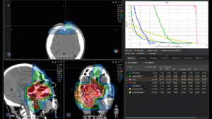 Animation: treatment plan adenocarcinoma