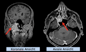 Beispiel HNO Indikation: Adenokarzinom