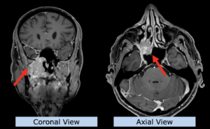 Example head and neck: adenocarcinoma