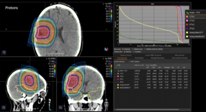 Low grade glioma treatment plan