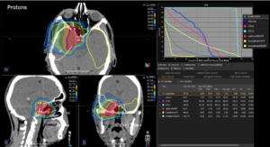 Treatment plan nasopharynx carcinoma