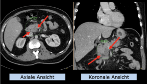 Beispiel Indikation Oberer Bauch: Pankreaskarzinom