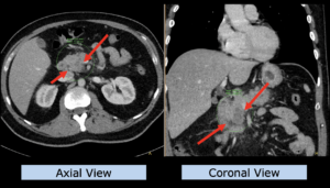 Example upper abdomen: pancreas carcinoma