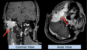 Example head and neck: adenoma of parotid gland