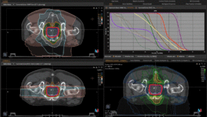 Animation: plan comparison prostate cancer