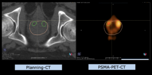 Example indication pelvis: Prostate cancer