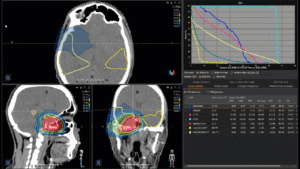 Animation: treatment plan nasopharynx carcinoma