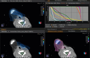 Animation Vergleich Bestrahlungsplanung Rhabdomyosarkom