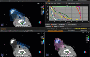 Animation: Plan Comparison Rhabdomyosarcoma