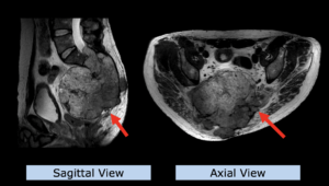 Example: sacral chordoma