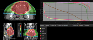 Treatment plan sacral chordoma