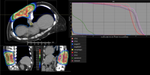 Treatment plan sarcoma