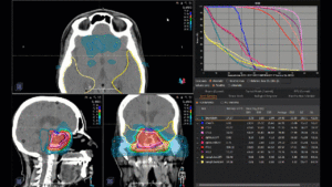 Animation: treatment plan skull base sarcoma