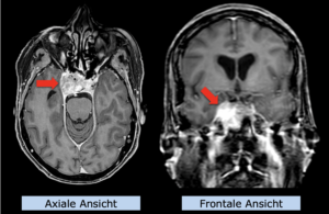 Beispiel: Sarkom der Schädelbasis