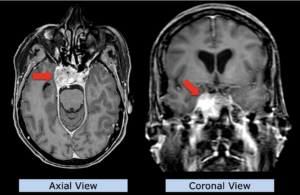 Example: skull base sarcoma