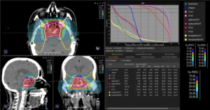 Treatment plan skull base sarcoma