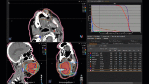 Animation: Treatment plan Squamous Cell Carcinoma