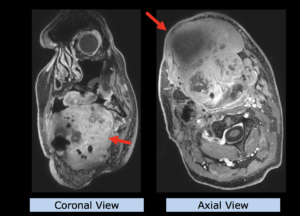 Example PATHY: Squamous Cell Carcinoma