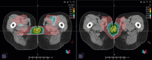 Animation: plan comparison vaginal cancer