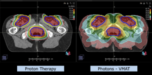 Example Indication Pelvis: Vaginal Cancer Plan Comparison