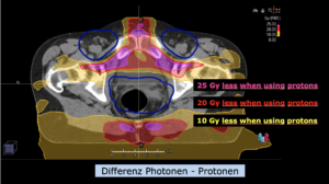 Vaginalkarzinom Dosisdifferenz II