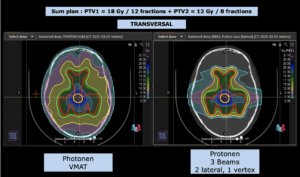 Bestrahlungsplanung Germinom - Ansicht transversal