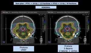 Treatment Plan Comparison Germinoma III
