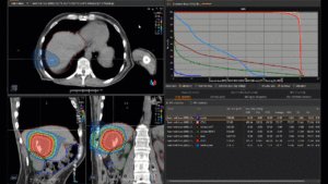 Animation Bestrahlungsplan Hepatozelluläres Karzinom