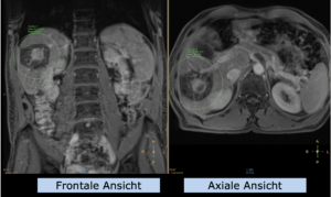 Beispiel Indikation Oberer Bauch: Hepatozelluläres Karzinom