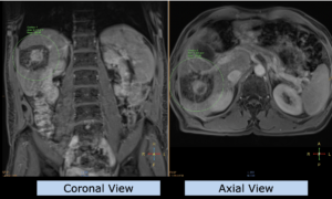 Example upper abdomen: hepatocellular carcinoma