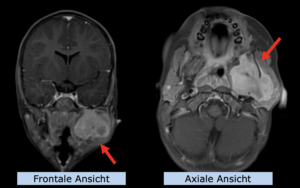 Beispiel Pädiatrie: Rhabdomyosarkom