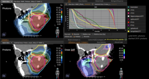 Plan Comparison: Rhabdomyosarcoma
