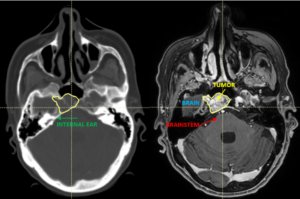 Skull base tumor diagnostic representation