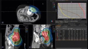 Animation: Treatment Plan Ewing Sarcoma