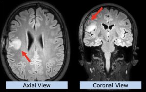 Example CNS Indication: Low Grade Glioma