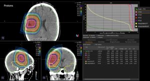 Beispiel ZNS Indikation: Low Grade Gliom - Bestrahlungsplan