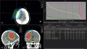 Animation: low grade glioma treatment plan