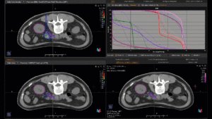Animation Vergleich Bestrahlungsplanung Pankreaskarzinom