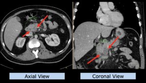 Example upper abdomen: pancreas carcinoma