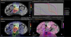 Treatment plan comparison pancreas carcinoma